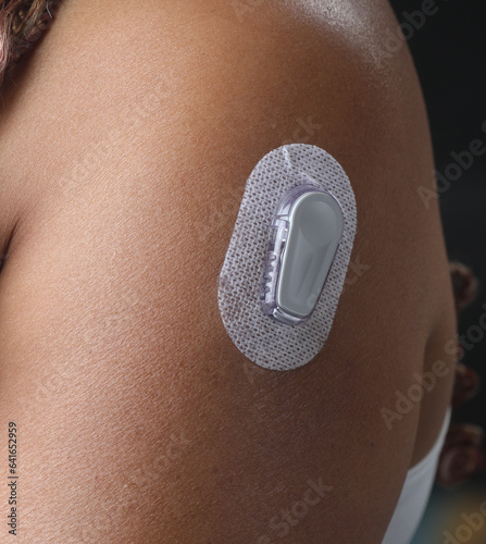Close-up Of A Woman Testing Glucose Level With A Continuous Glucose Monitor On Her Arm