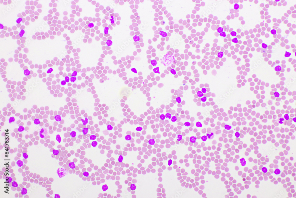 Picture of acute lymphocytic leukemia or ALL cells in blood smear, analyze by microscope, 400x