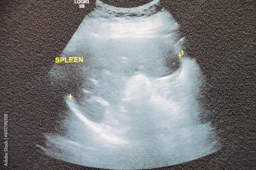 The Spleen of Normal size and texture with no focal lesion, S.V Splenic vein is not dilated, Pelviabdominal ultrasound of a female patient, The spleen acts as a blood filter, selective focus photo