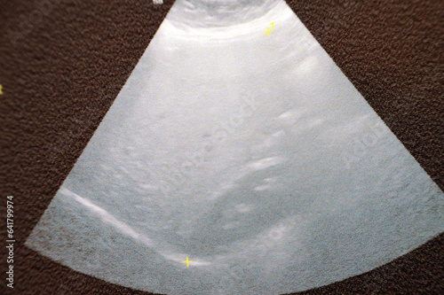 Enlarged liver size 19.7 CM with uniform texture bright, no focal lesions or or dilated IHBRs intrahepatic biliary radicals, P.V Portal vein is not dilated, Real time ultrasound of abdomen and pelvis photo