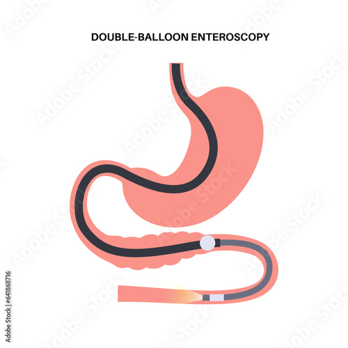 Double balloon enteroscopy
