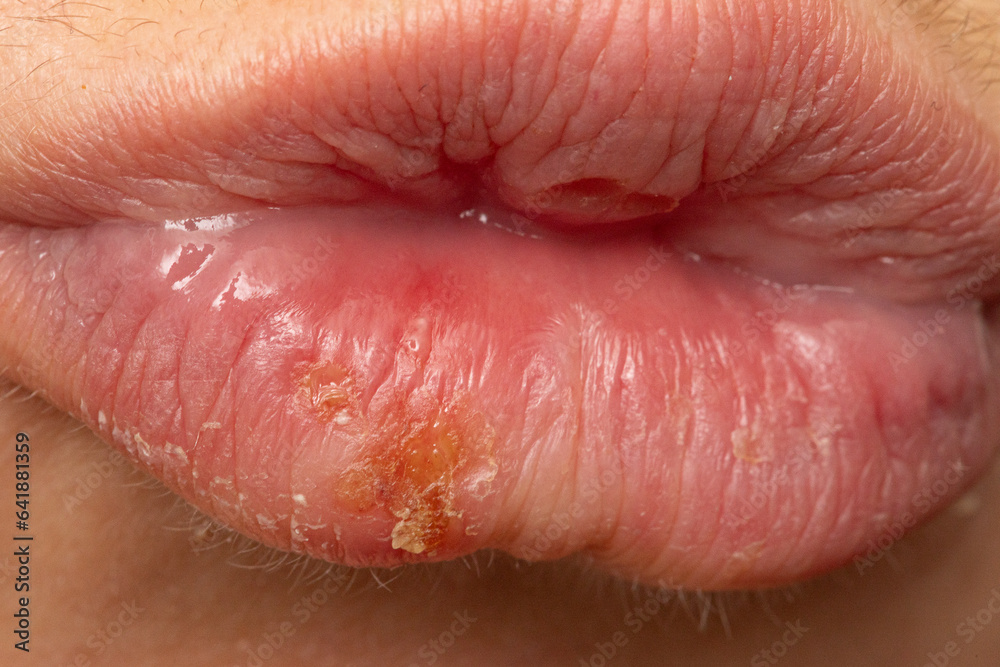 Fototapeta premium Macro of woman's lips with cold sores