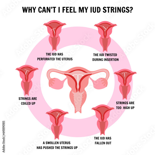  IUD intrauterine device, medical information and illustration