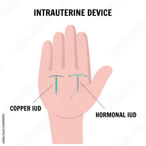  IUD intrauterine device, medical illustration