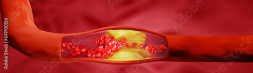 Canvas Print Hyperlipidemia or arteriosclerosis