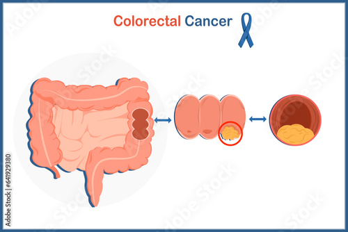 Medical illustration vector concept, digestive system of human colon and colon cancer illustration.isolated on white background,flat style.