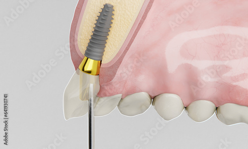 dental implant side view