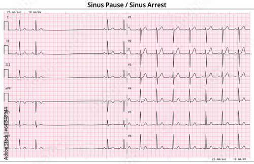 Sinus Arrest - Sinus Pause - ECG Paper 12 Lead - Vector Medical Illustration