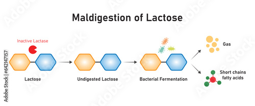 Maldigestion of Lactose Concept Design. Vector Illustration.