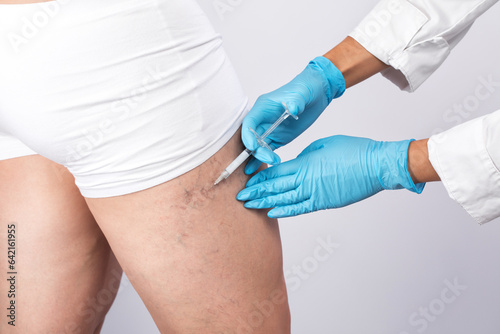 doctor shows  the dilation of small blood vessels of the skin on the leg. Medical inspection and treatment of Telangiectasia. sclerotherapy procedure photo