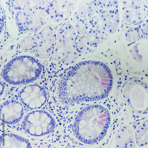 Camera photo of gastric mucosa, showing intestinal metaplasia (Paneth cells), magnification 400x, photograph through a microscope photo