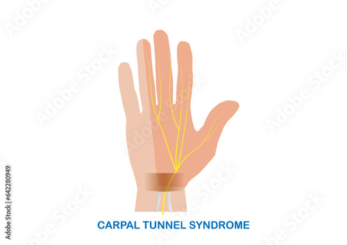 Vector illustration of median nerve entrapment at the wrist or carpal tunnel syndrome.