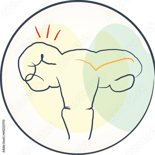 Uterine fibroids are tumors that grow in a woman's womb (uterus)
