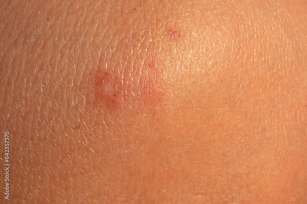 close-up of insect bites on the skin. Allergic reaction. Skin close-up of insect bites on the skin. Allergic reaction. Skin