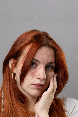 Young woman with facial skin rash. Dermatological problems photo