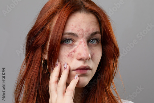 Young woman with facial skin rash. Dermatological problems photo