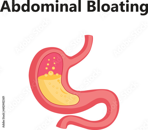 Gastroesophageal reflux disease stomach with main parts labeled. Medical vector illustration with the shape of a sick human body, fragments of healthy and sick stomach isolated on a white background