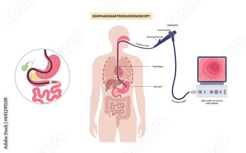 Esophagogastroduodenoscopy medical procedure