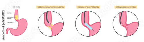 Achalasia treatments procedures