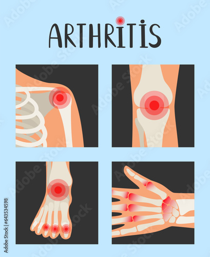 Joints of the human skeleton with pain red dots. Rheumatoid arthritis vector illustration about inflammation