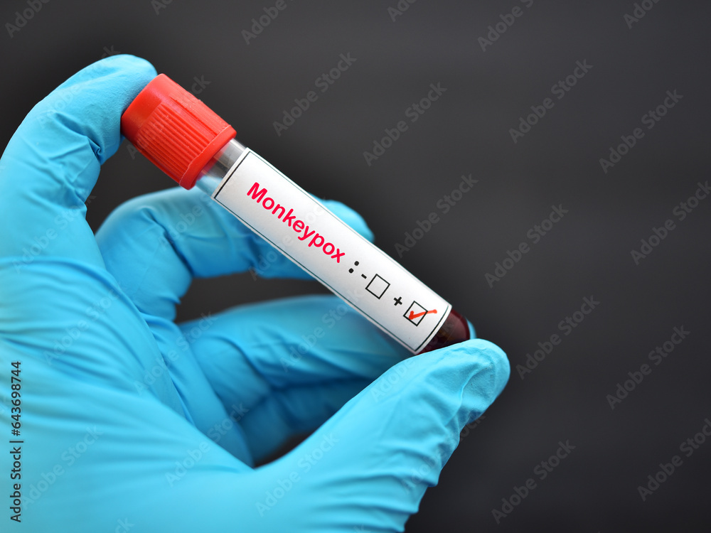 Obraz premium Monkeypox positive, lab technician holding blood sample tube positive with Monkeypox virus