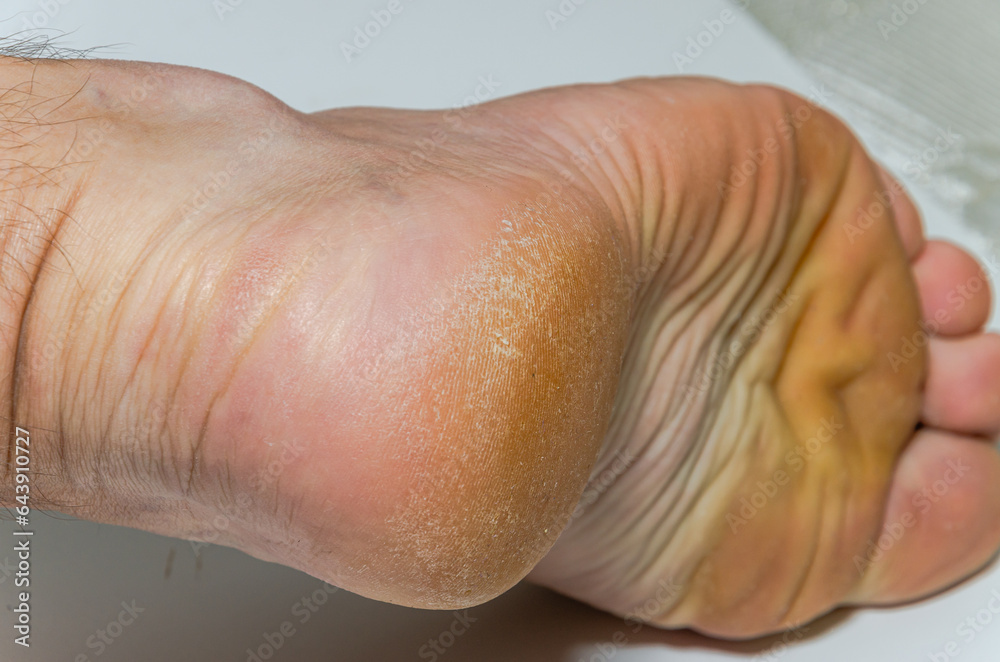 Fototapeta premium Cracked scruffy heel before pedicure