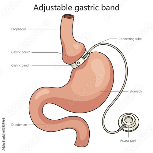 Adjustable gastric band stomach band structure diagram schematic vector illustration. Medical science educational illustration