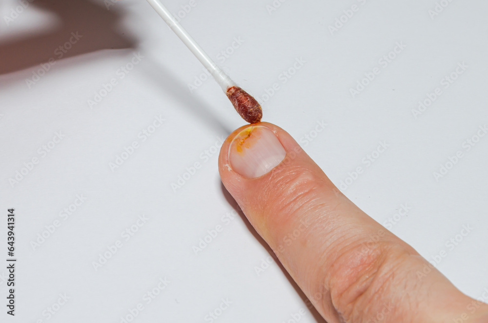 First aid for a patient with a broken fingernail Stock Photo Adobe Stock