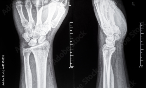 X-ray image of Human wrist joint. CT Scan Film.