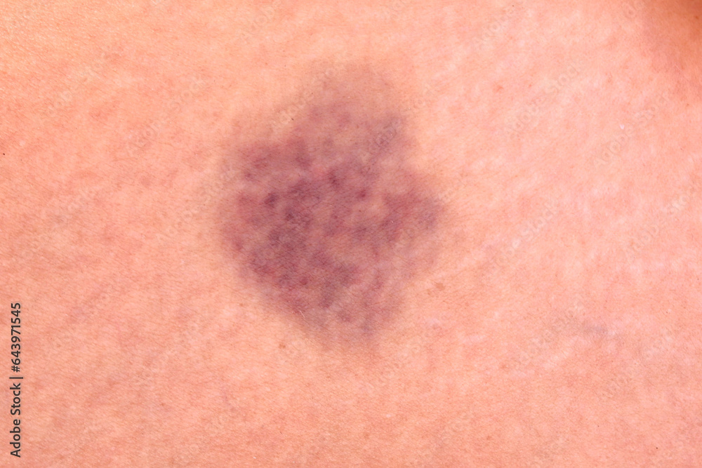 close up hematoma bruise skin from woman body. close up hematoma bruise skin from woman body.
