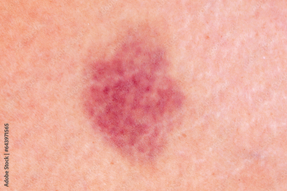 close up hematoma bruise skin from woman body. close up hematoma bruise skin from woman body.