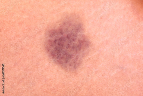 close up hematoma bruise skin from woman body.