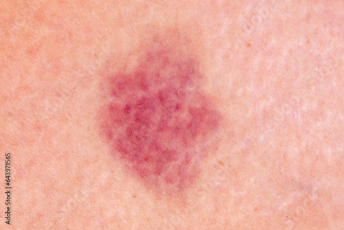 close up hematoma bruise skin from woman body.