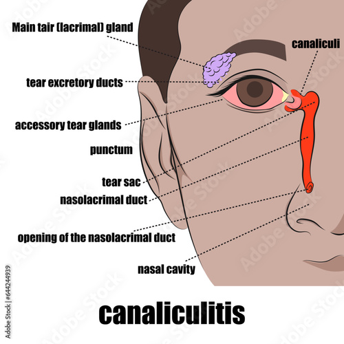 canaliculitis, inflammation of the tear duct (usually caused by an infection). photo