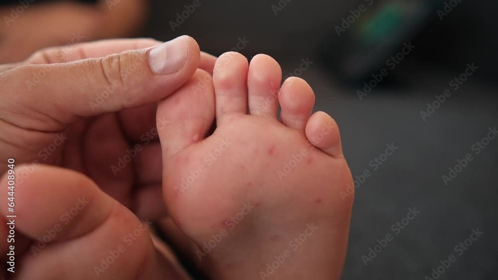 Close up feet of a child with a rash, Coxsackie virus, chickenpox