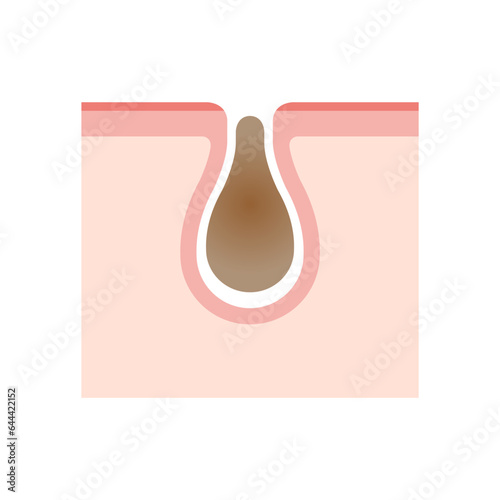 Illustration of skin care , skin cleaning (cross section of skin) | dirt in pores