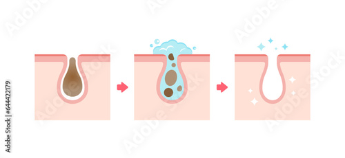 Mechanism illustration of skin care , skin cleaning (cross section of skin)