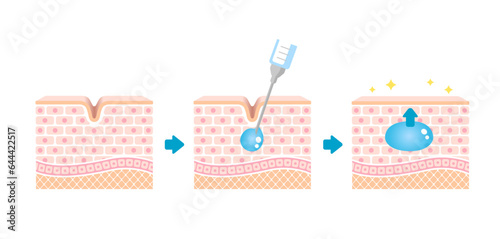 Mechanism illustration of hyaluronic acid injection (cross-sectional view of the skin)