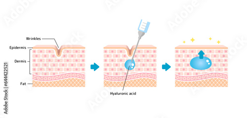 Mechanism illustration of hyaluronic acid injection (cross-sectional view of the skin)