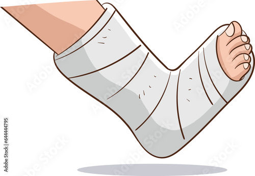 vector illustration of Orthopedic plaster or fiberglass cast, broken leg, bone fracture