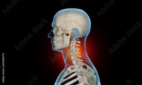 Side view of cervical section of spine injury and pain photo