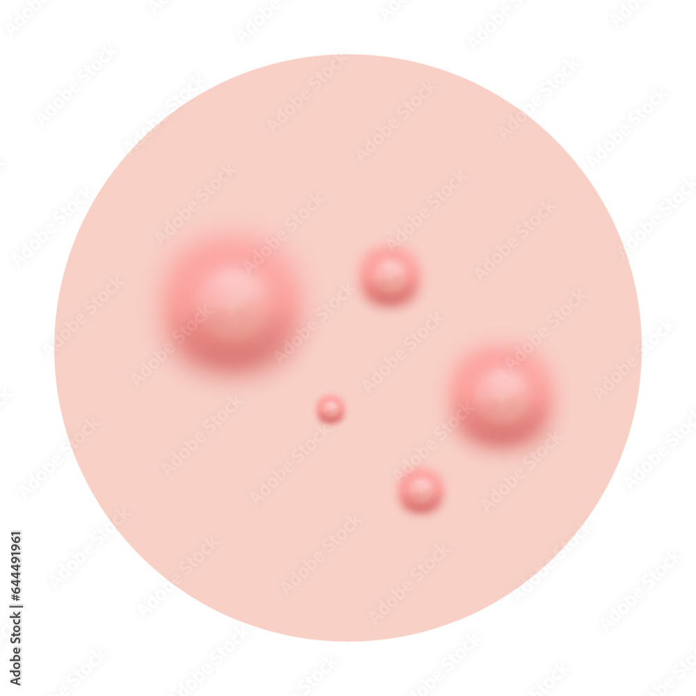 Fototapeta premium Acne skin pimple, vector illustration
