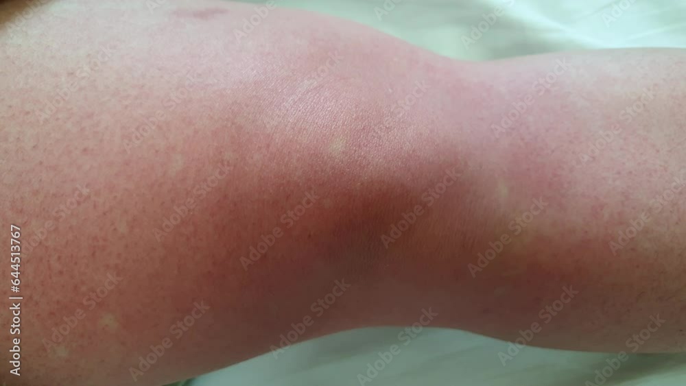 Close up Skin of Dengue fever patient blood red spots under skin mosquitoes tropical disease Close up Skin of Dengue fever patient blood red spots under skin mosquitoes tropical disease