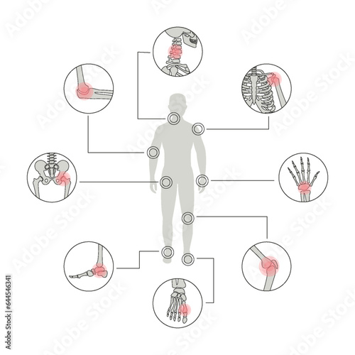Vector Illustration of arthritis disease
