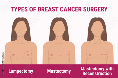 Types of breast cancer surgery lumpectomy, mastectomy, reconstruction. Medical illustration of women chest with scar after surgery. Breast Cancer Awareness Month. Women health care