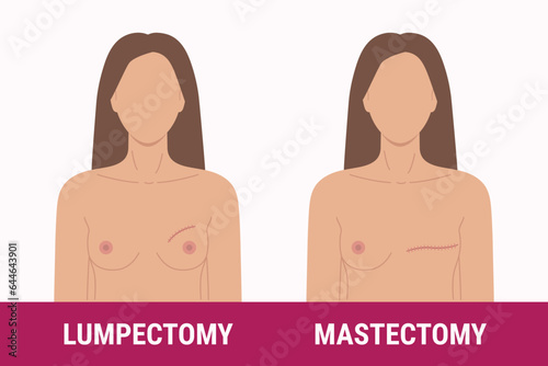 Types of breast cancer surgery lumpectomy, mastectomy. Medical illustration of women s chest with scar after surgery. Breast Cancer Awareness Month. Women health care. Hand drawn illustration