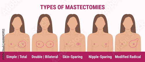 Types of mastectomy double, skin-sparing, nipple-sparing, total. Breast removal surgery. Medical illustration of women chest with scar after surgery. Breast Cancer Awareness Month.