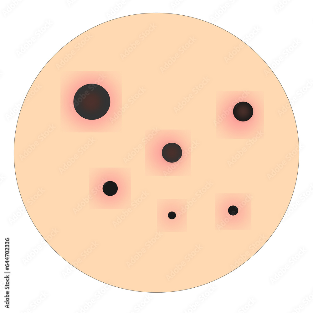 Fototapeta premium vector acne face beauty illustration