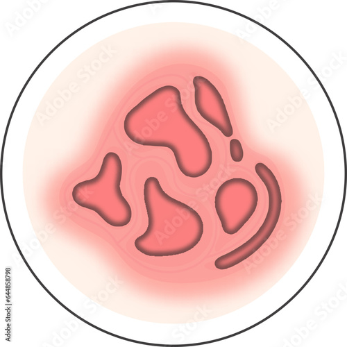 Red And Peach Illustration Of Psoriasis Skin Disease Circle Icon.