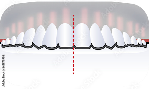 Red and White Illustraiton Of Crossbite Teeth Flat Icon.